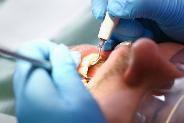 Best Emergency Treatment for Dental Infections or Abscesses in Centreville, AL